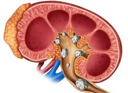 Illustration for article titled Daftar Nama Obat Batu Ginjal